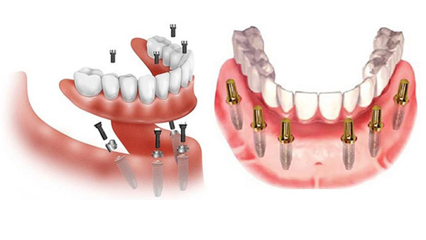Cay Ghep Implant All On 4 3