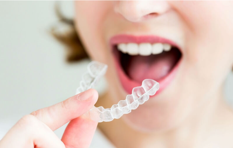 nieng-rang-trong-suot-invisalign