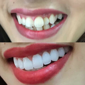Răng khấp khểnh có bọc sứ được không