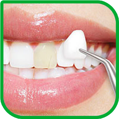 Veneer
